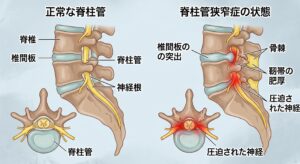 脊柱管狭窄症のイメージ画像